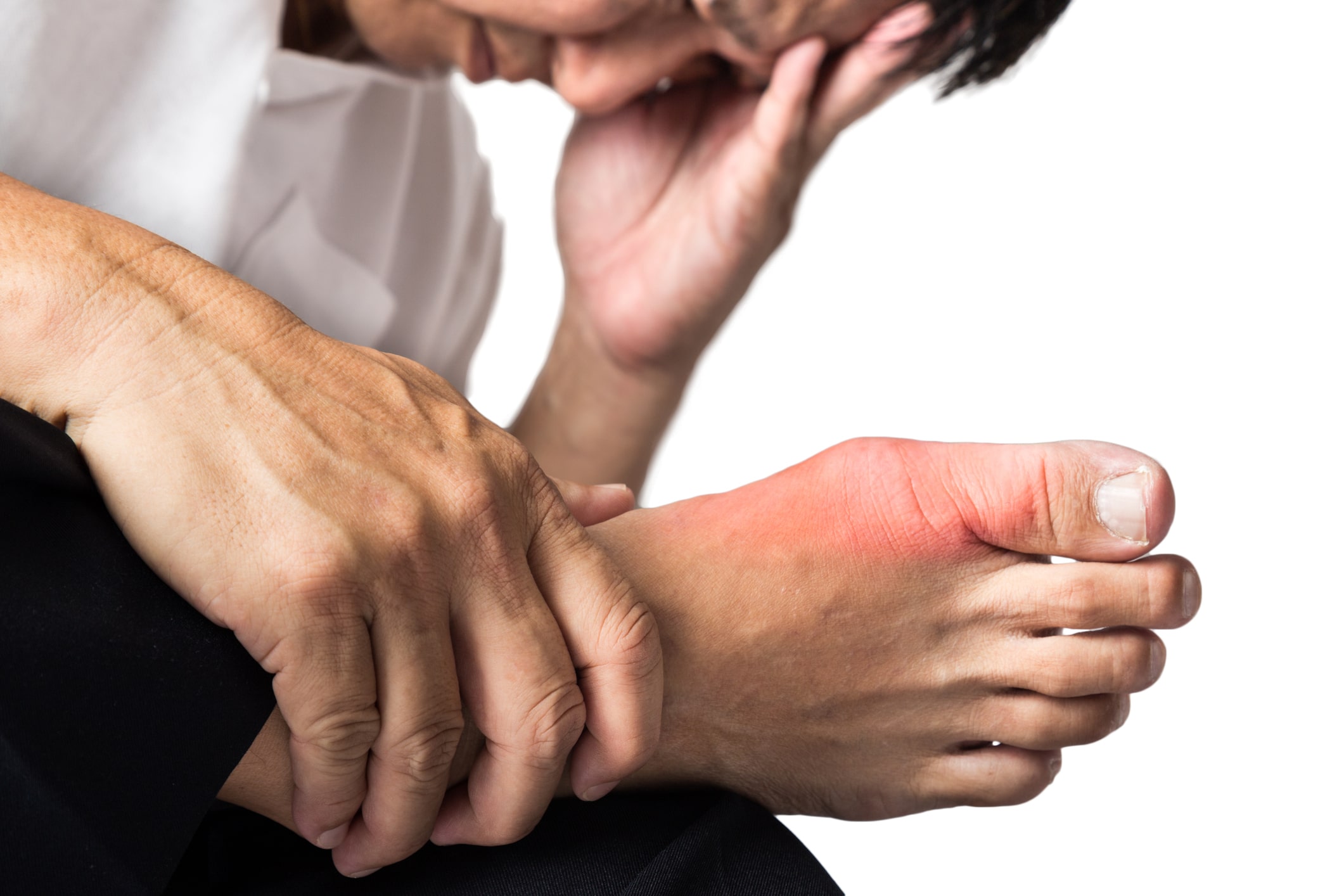 3 Signs That You May Have Gout