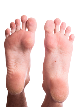What Are the Treatments for Corns and Calluses