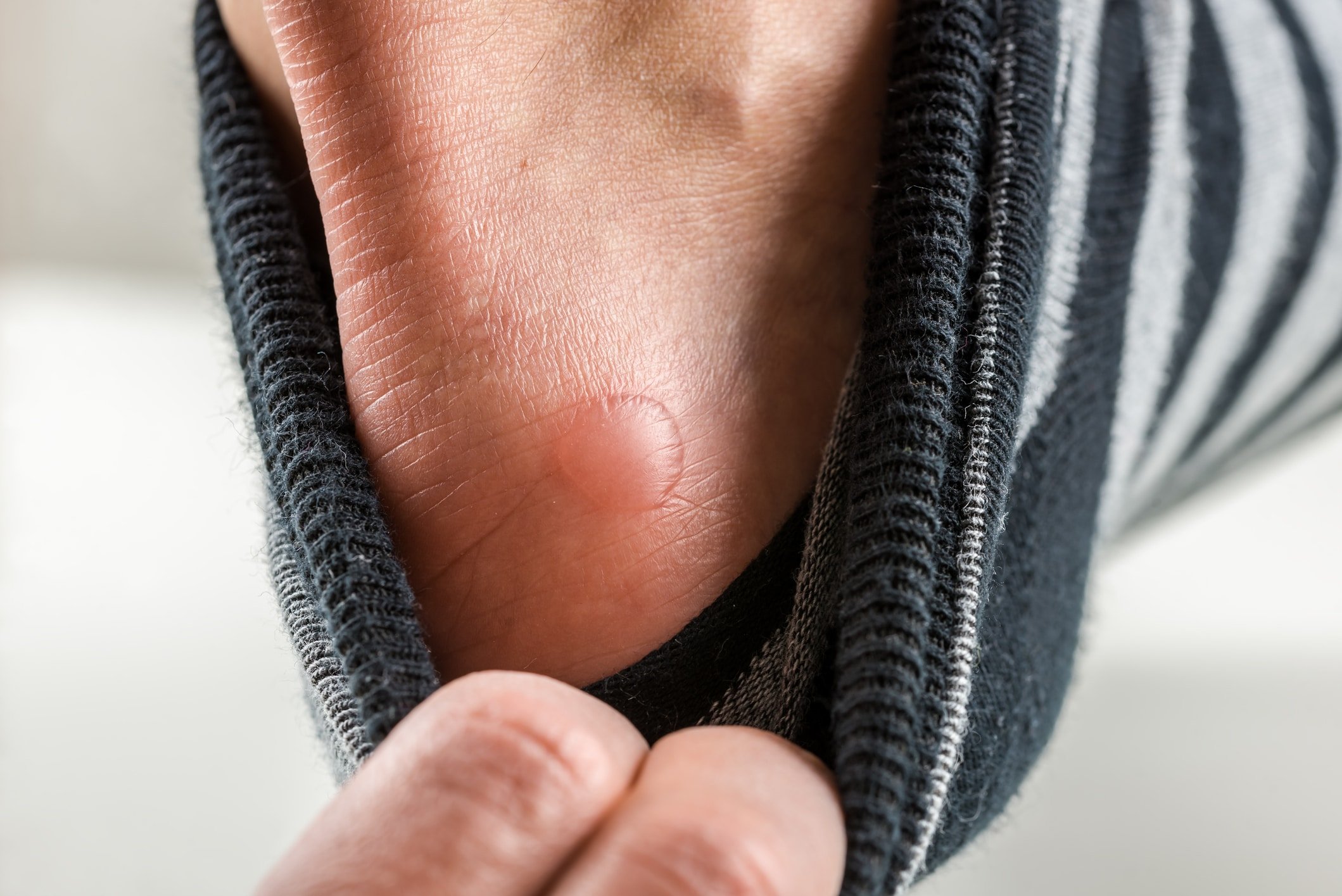 What To Do About Painful Blisters On Your Feet