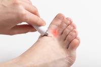 Managing Athlete’s Foot Effectively