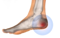 Common Culprits of Heel Pain