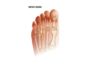 Definition and Common Symptoms of Morton’s Neuroma